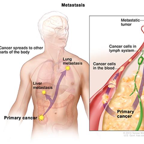 Description of metastasis