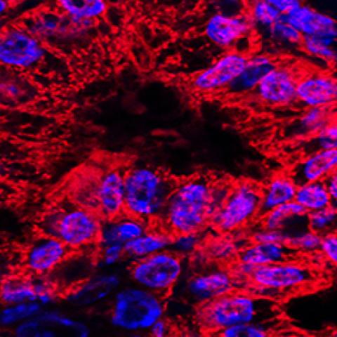 Mitochondrial shape in pancreatic cancer
