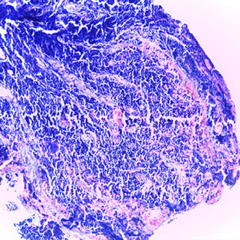 small cell lung carcinoma