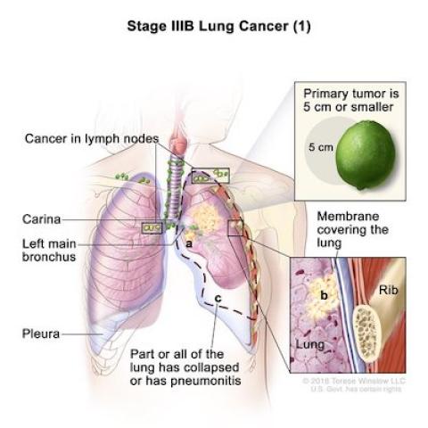 Lung Cancer, Stage IIIB (1)