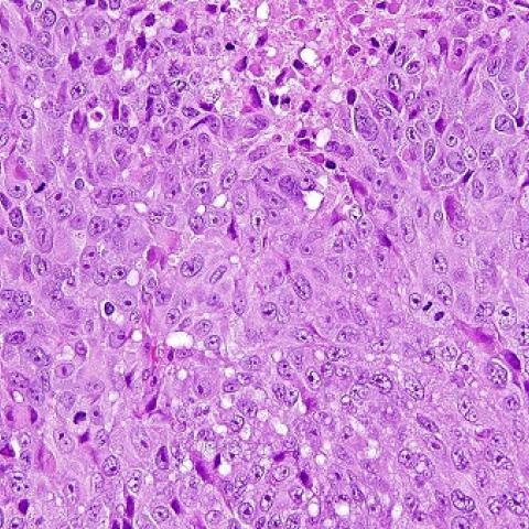 Uveal melanoma cells