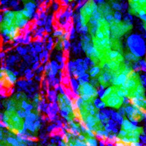 Nanoparticles in brain metastases