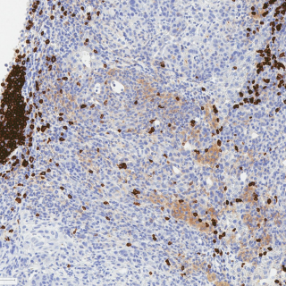 CD45R-stained IHC image depicting B cells within a tertiary lymphoid structure in a triple-treated cholangiocarcinoma tumor