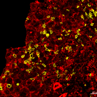 engineered natural killer cells (yellow) can expand in solid tumors and kill tumor cells (red)