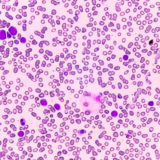 Acute myeloid leukemia. Image credit: iStock