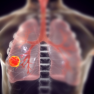 Computer illustration of lung cancer