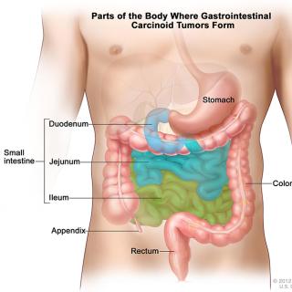 The middle portion of the gastrointestinal tract is a common location for cancerous neuroendocrine tumors to form.