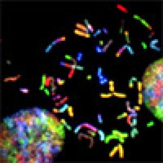 Glioblastoma chromosomes