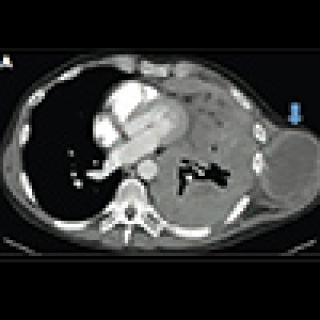CT scan of a patient with mesothelioma