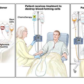 stem cell transplant