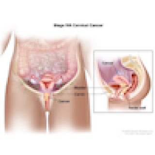 Cervical Cancer Stage IVA