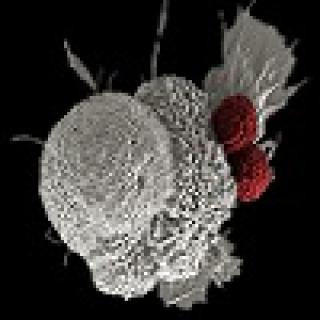 oral squamous cancer cell (white) being attacked by two cytotoxic T cells (red), part of a natural immune response