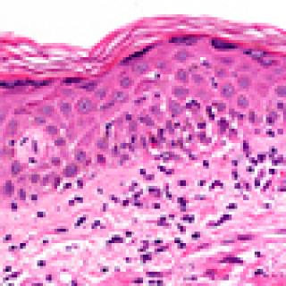 Photomicrograph showing graft-versus-host disease in the skin