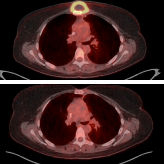 Lymphoma mass before and after treatment