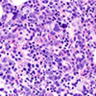 Samples from acute myeloid leukemia patients with the splicing factor mutation