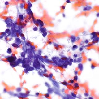 small cell lung carcinoma