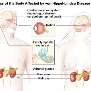 Areas of the body affected by von Hippel-Lindau (VHL) disease. Credit: NCI Visuals