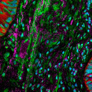 lung cancer desmoplasia