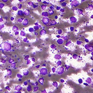 diffuse large B-cell lymphoma