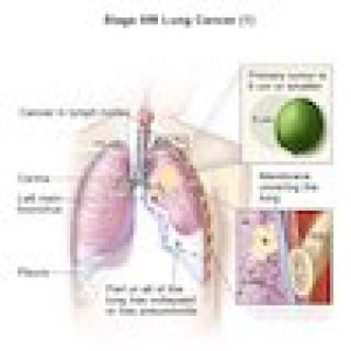 Lung Cancer, Stage IIIB (1)