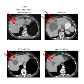 CT abdomen