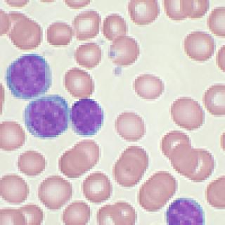 Chronic lymphocytic leukemia cells