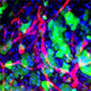 Nanoparticles in brain metastases