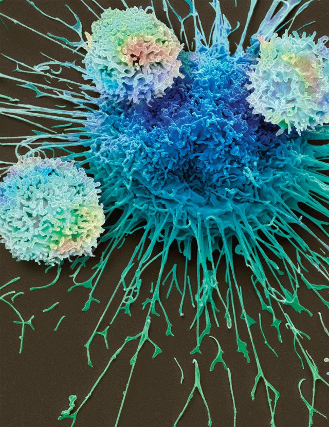 CAR T Cells for Solid Tumors - scanning electron microscopy image of CAR T cells attacking a lung cancer cell