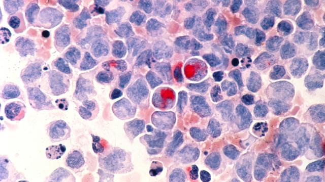 Acute myelocytic leukemia