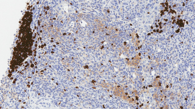 CD45R-stained IHC image depicting B cells within a tertiary lymphoid structure in a triple-treated cholangiocarcinoma tumor