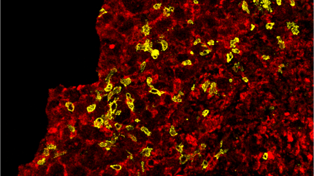 engineered natural killer cells (yellow) can expand in solid tumors and kill tumor cells (red)