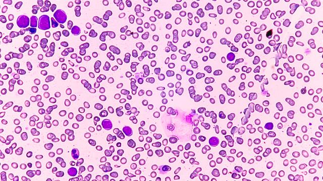 Acute myeloid leukemia. Image credit: iStock