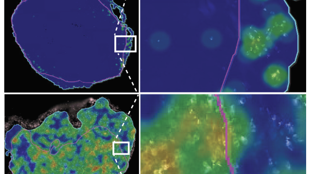 Spatial heatmap of CD3+ T cells in small cell lung cancer (SCLC) tumors. Top: Notch1 gene inactive, “cold” SCLC with T cells located on the tumor periphery (immune-excluded). Bottom: Notch1 gene active, “hot” SCLC with abundant T cell tumor infiltration (immune-inflamed).