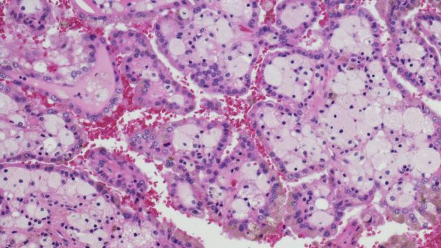 Micrograph of renal cell carcinoma. 