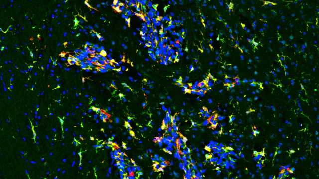 Fluorescent image showing the protein CSF-1R (green), microglia (red), and cell nuclei (blue) in a breast cancer brain metastasis model. Microglia cells near and inside the brain tumors are expressing the CSF-1R protein (yellow)