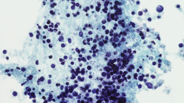 Micrograph of small cell carcinoma