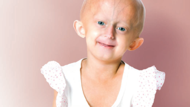 Beandri, a young girl with progeria