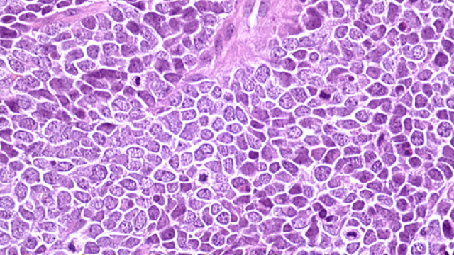 Hematoxylin and eosin staining of a tissue section from a Merkel cell carcinoma tumor.