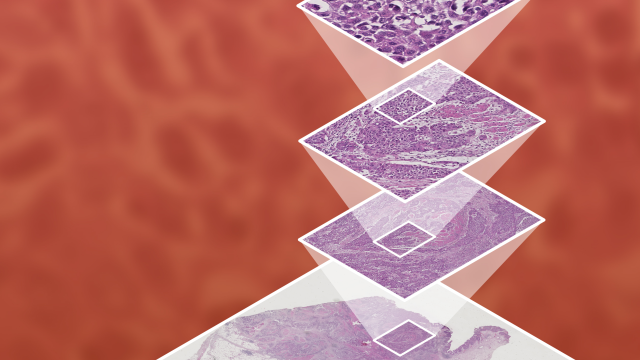 Smarter Prostate Cancer Diagnosis