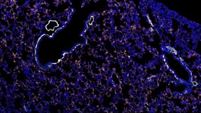 This image represents the early changes that occur in the lung in response to a localized primary tumor distant from the lung. 