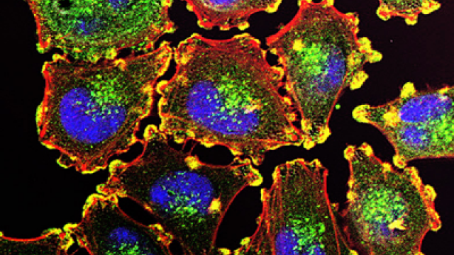actin-rich podosomes (yellow) in melanoma cells