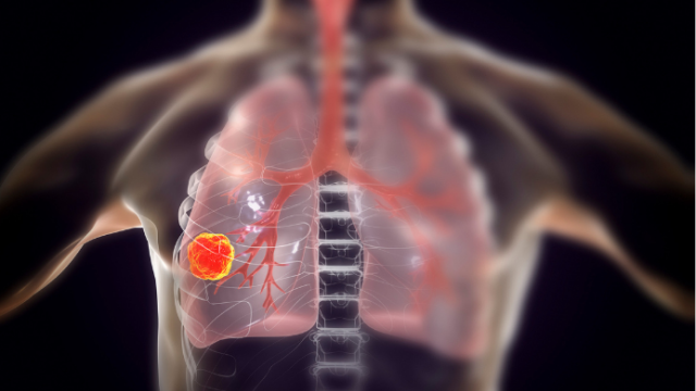 Computer illustration of lung cancer