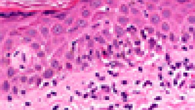 Photomicrograph showing graft-versus-host disease in the skin