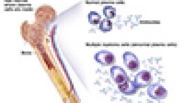 Multiple myeloma