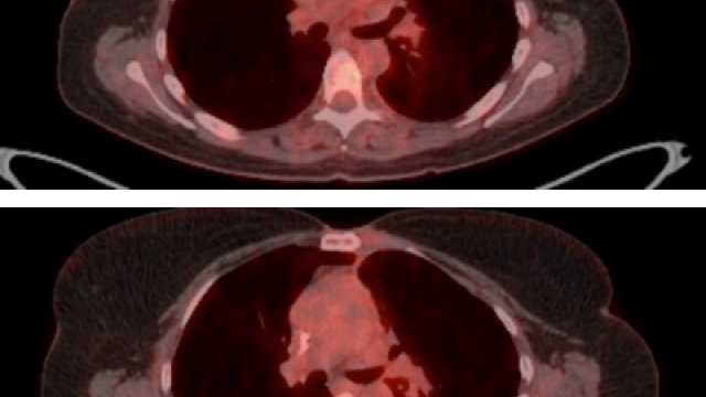 Lymphoma mass before and after treatment