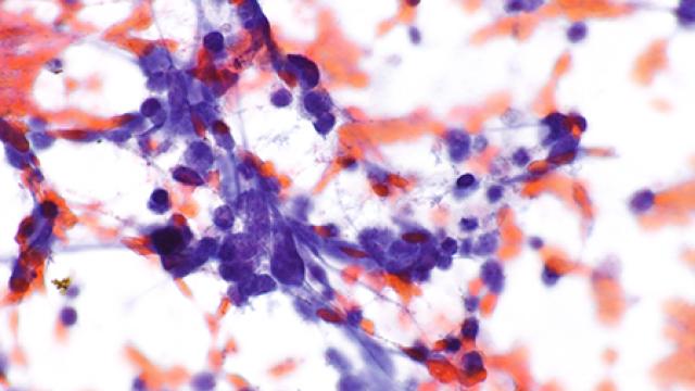 small cell lung carcinoma