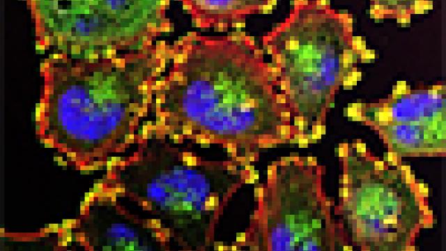 Metastatic melanoma cells