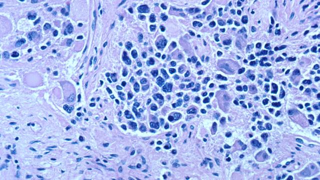 neuroblastoma cells