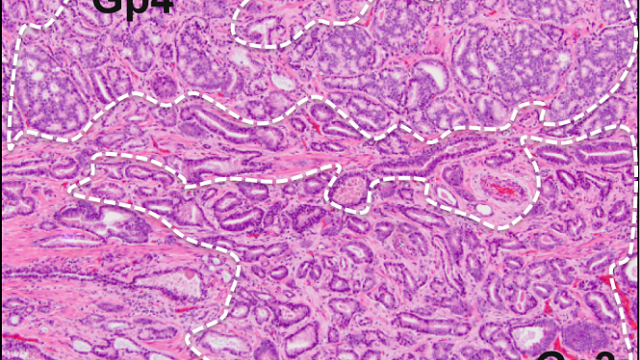 A prostate cancer tissue sample with low-grade (Gp3) and high-grade (Gp4) regions.