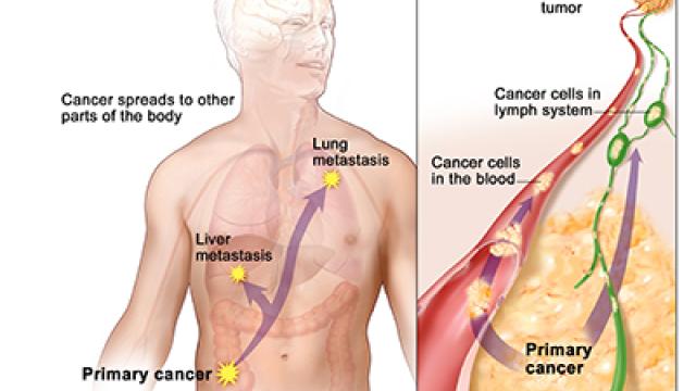Description of metastasis